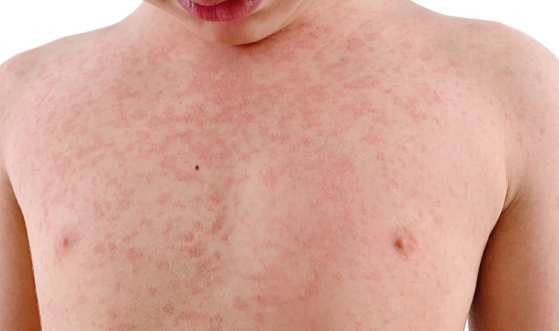 Salud Pública Emite Alerta Epidemiológica Por Sarampión; No Hay Casos En Rd